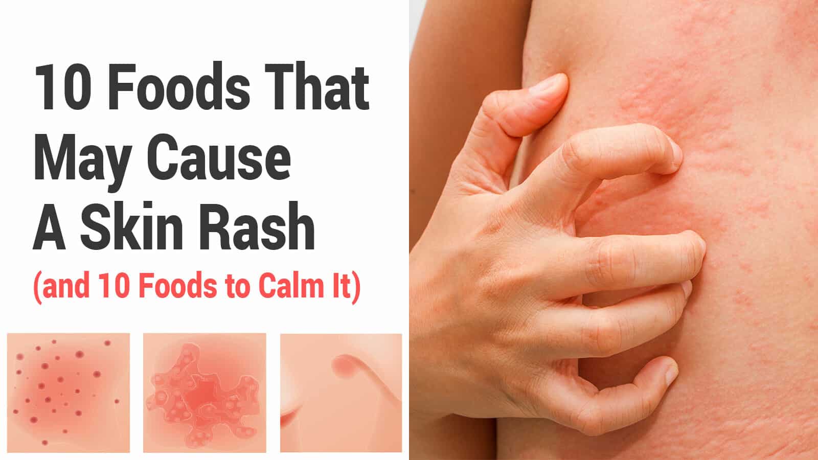 10 Foods That May Cause A Skin Rash (and 10 Foods to Calm It)