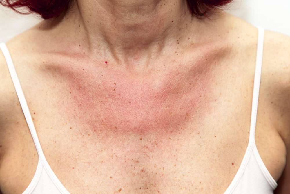 10 Symptoms of Latex Allergy