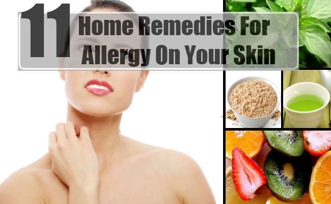 11 Home Remedies For Allergy On Your Skin