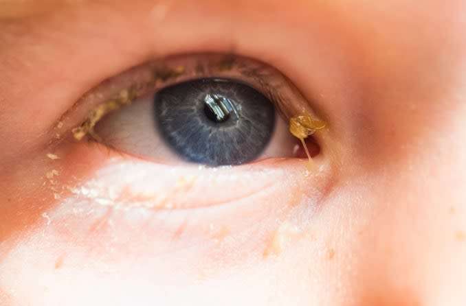 11 Homeopathic remedies for eye discharge