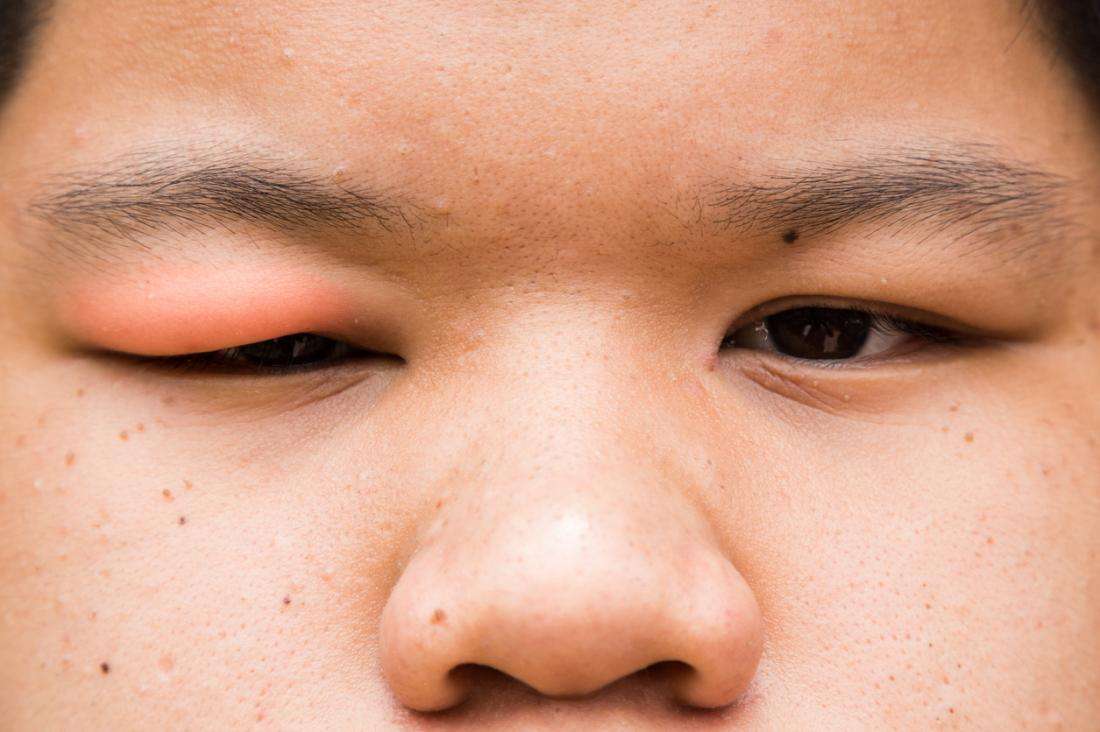 12 causes and treatments of a swollen eyelid: Stye ...