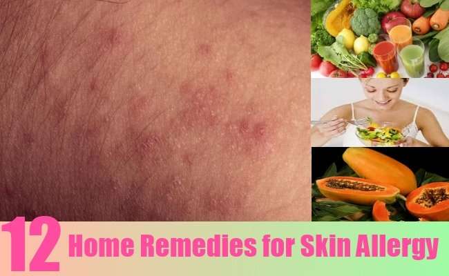 12 Home Remedies for Skin Allergy  Natural Home Remedies ...