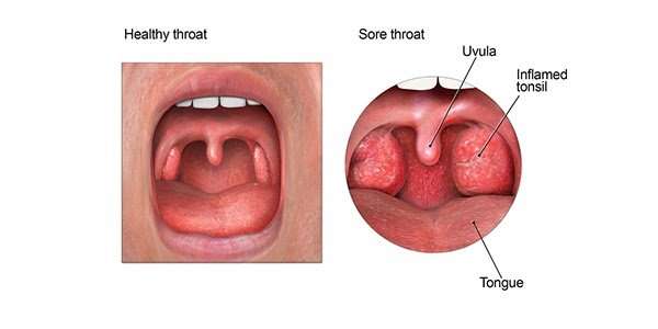 28+ White Spots On Tonsils No Pain PNG