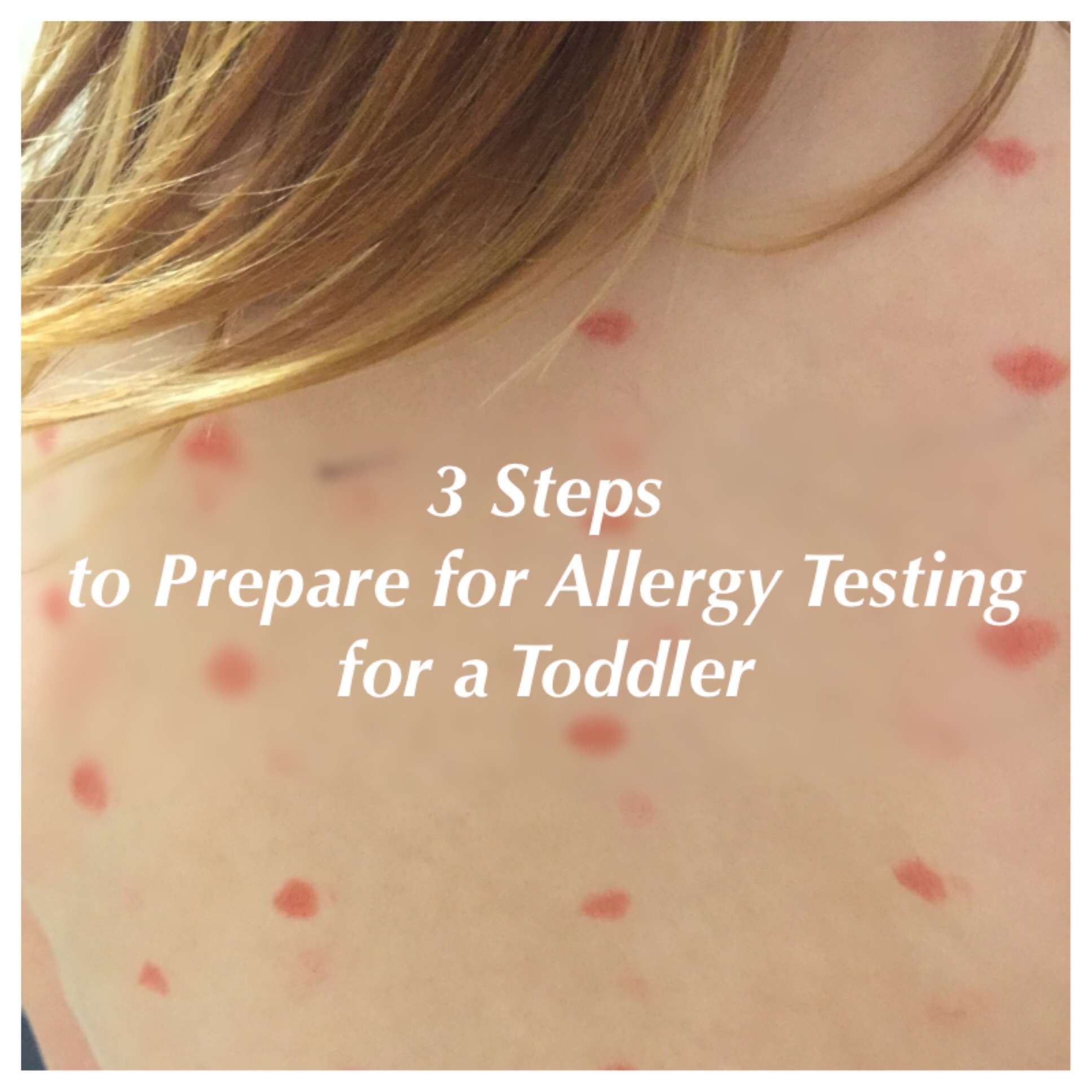 3 Steps to Prepare for Allergy Testing for a Toddler  Happy Family Blog