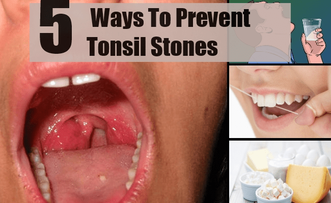 5 Best And Effective Ways For Tonsil Stones Prevention ...