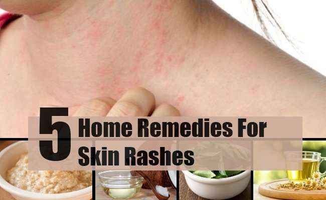 5 Home Remedies For Skin Rashes