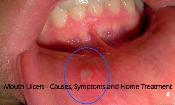 5 Powerful Mouth Ulcer Canker Sore Treatment