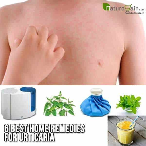 6 Best Home Remedies for Urticaria to Get Rid of Hives