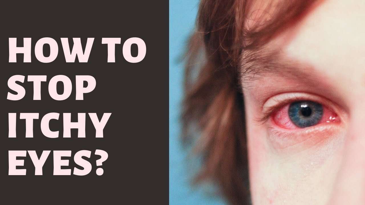 6 itchy eyes home remedy
