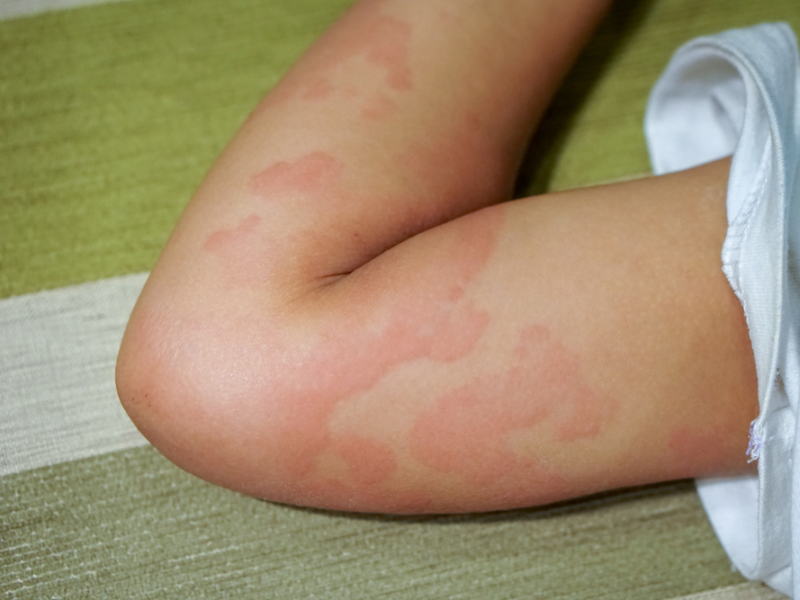 8 signs you might be having an allergic reaction to ...