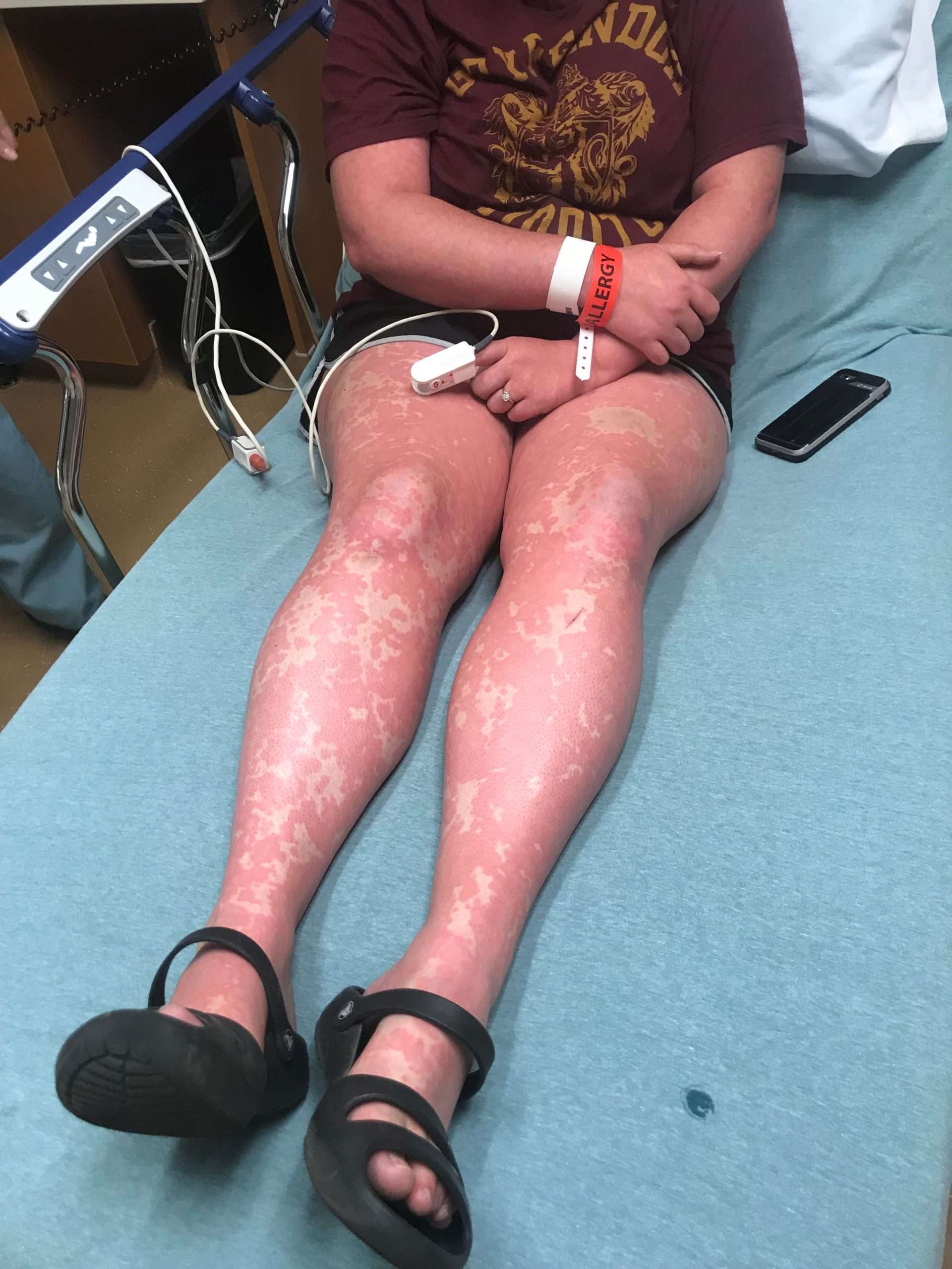A delayed reaction to an allergy test leads to an ER visit ...