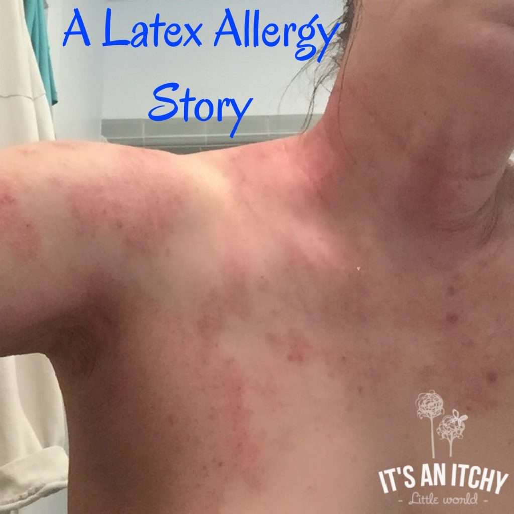 A Latex Allergy Story