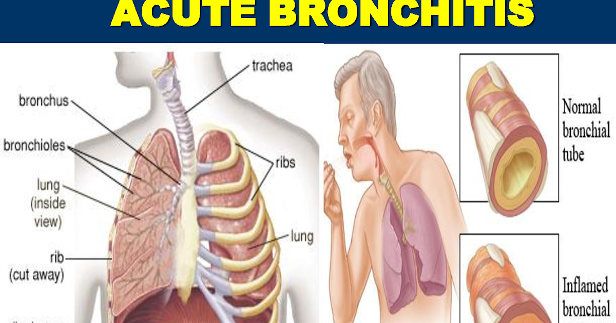 Acute Bronchitis and its Causes