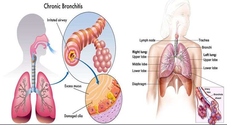 Acute Bronchitis: How You Can Prevent It