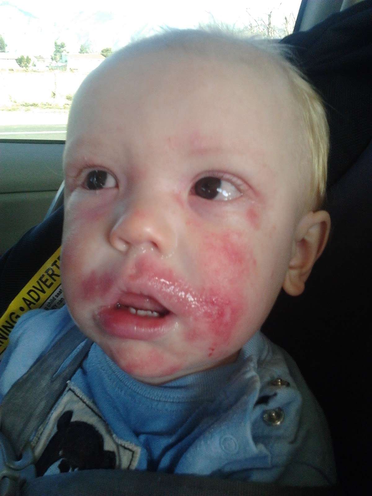 Adams Family: Severe Allergy Induced Eczema On My Infant.