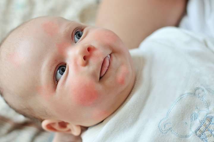 All About Baby Allergies: Common Food Allergies, Causes ...