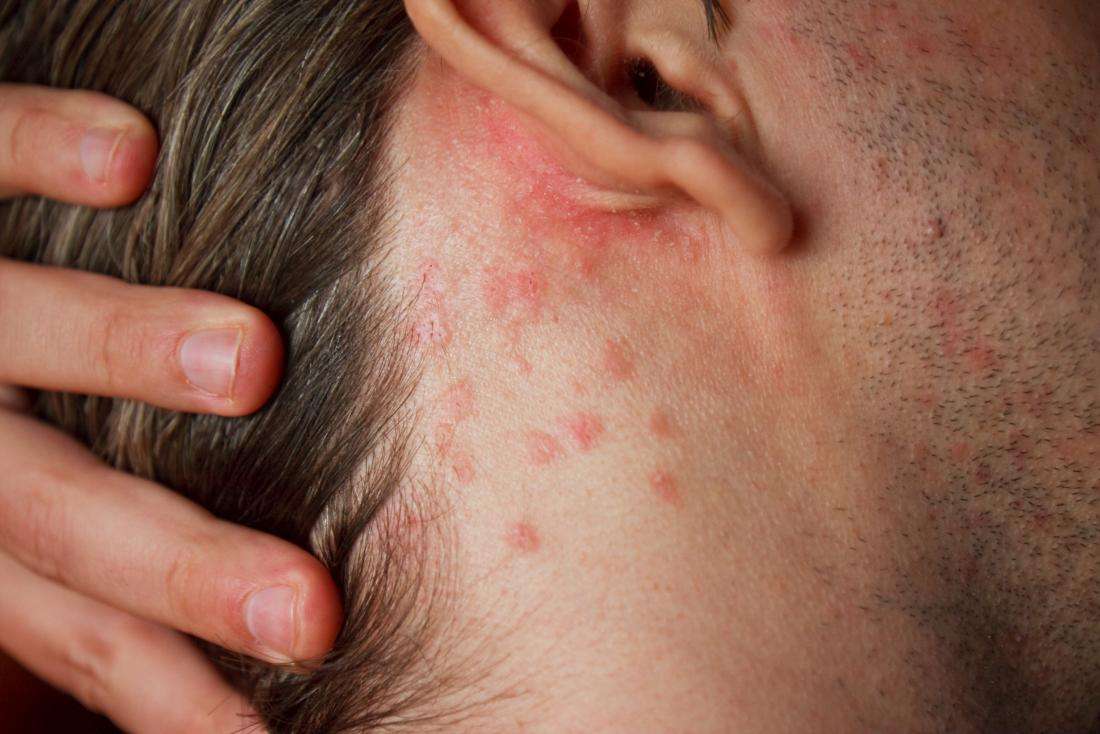 Allergen Factor: What Can Cause A Rash Behind Your Ear