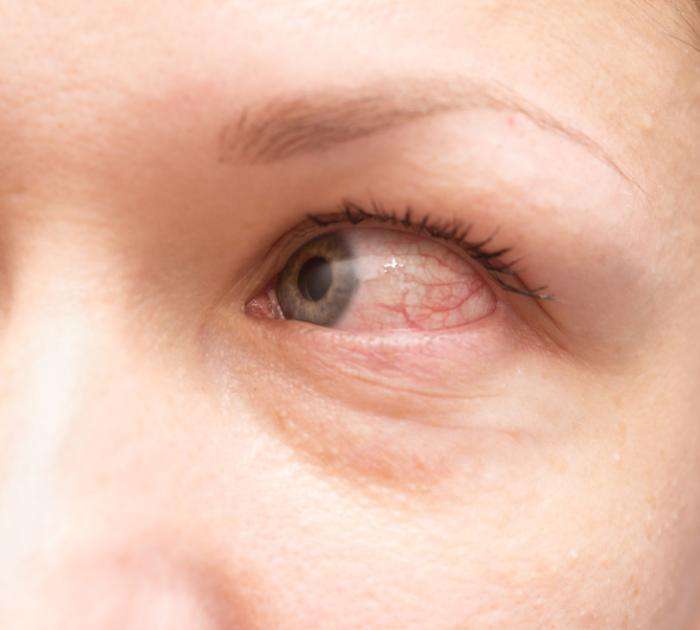 Allergic conjunctivitis: Treatment, symptoms, and causes