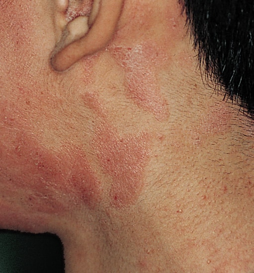 allergic contact dermatitis treatment