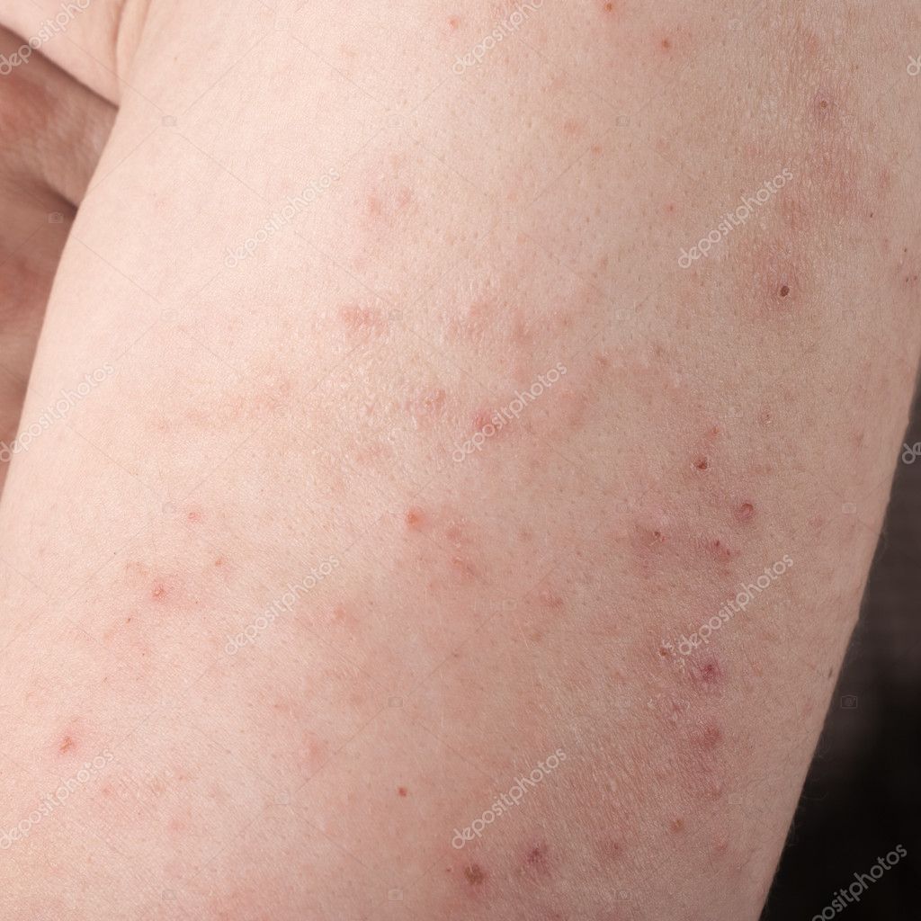 Allergic rash dermatitis  Stock Photo © librakv #10766042