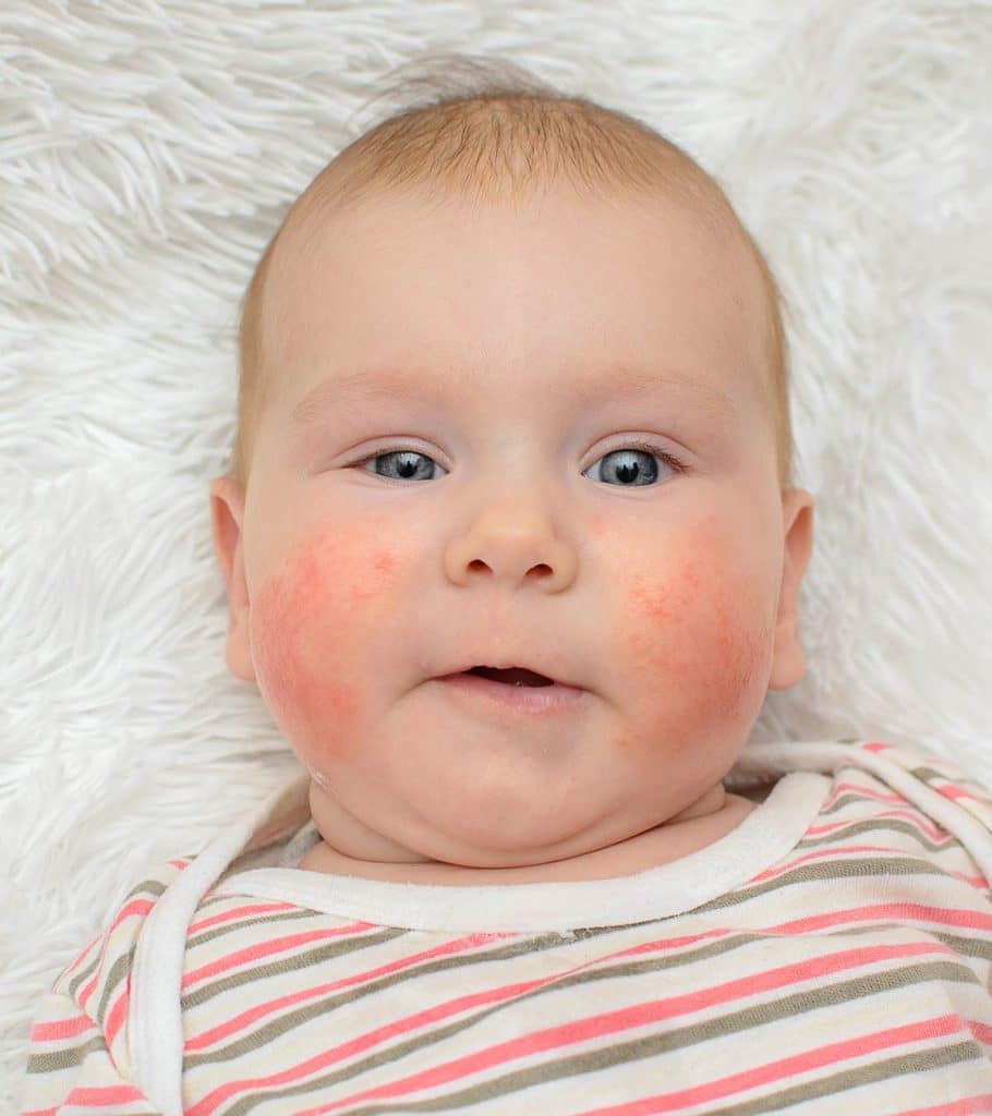 Allergic Reaction Hives On Baby Treatment