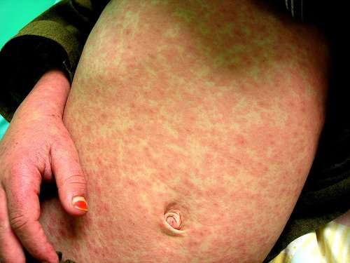 Allergic Reaction Rash to Penicillin Antibiotic