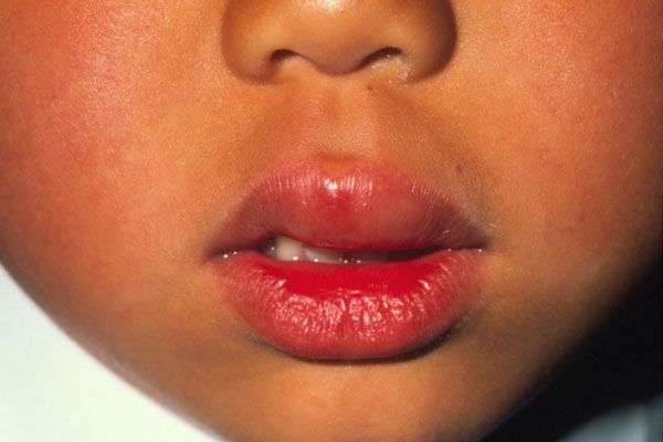 Allergic reaction Swollen upper lip of a six year