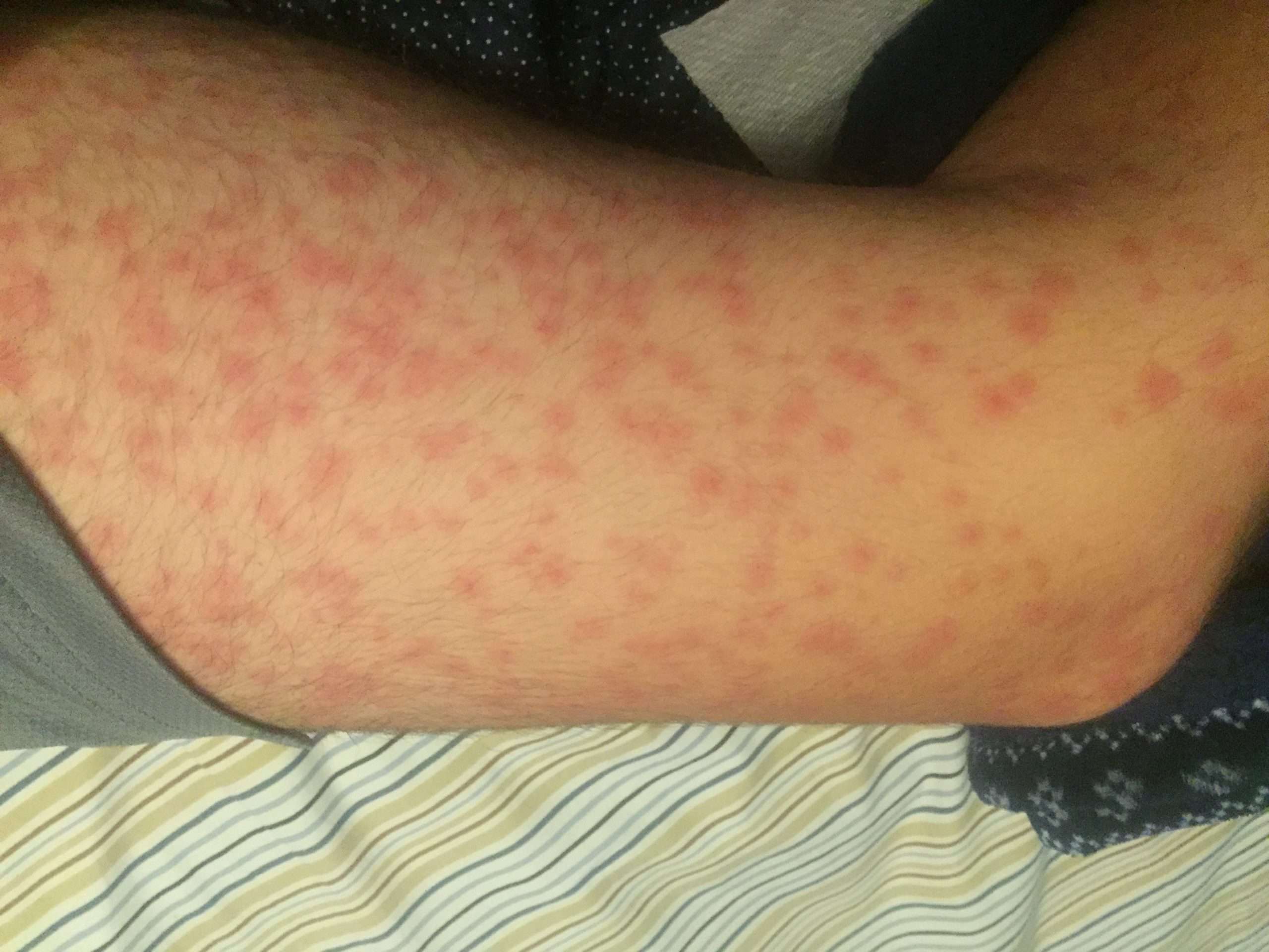 Allergic Reaction to Amoxicillin: Rash, Hives, Oh My! Home ...