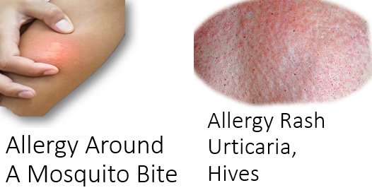 Allergic Reaction to Mosquito Bites