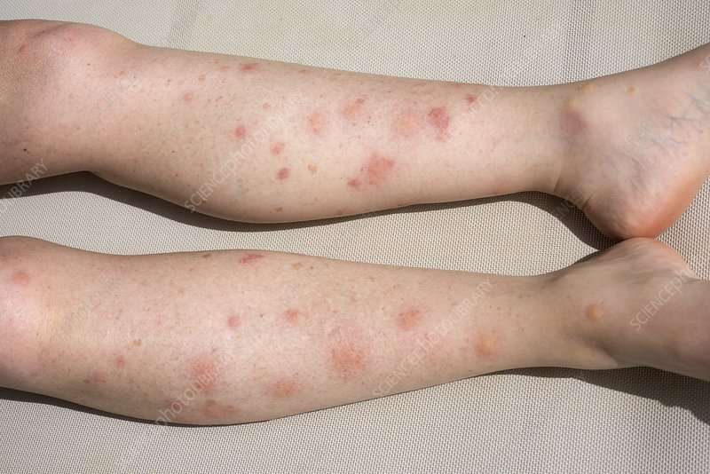 Allergic reaction to mosquito bites.