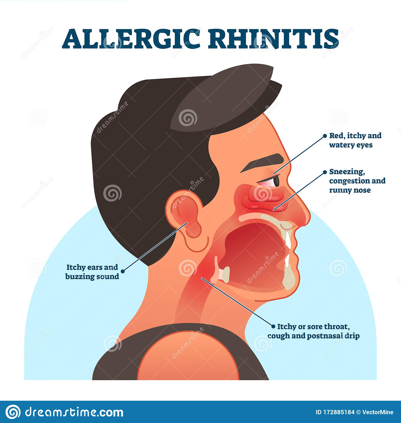 Allergic Rhinitis Medical Diagram, Vector Illustration Labeled ...