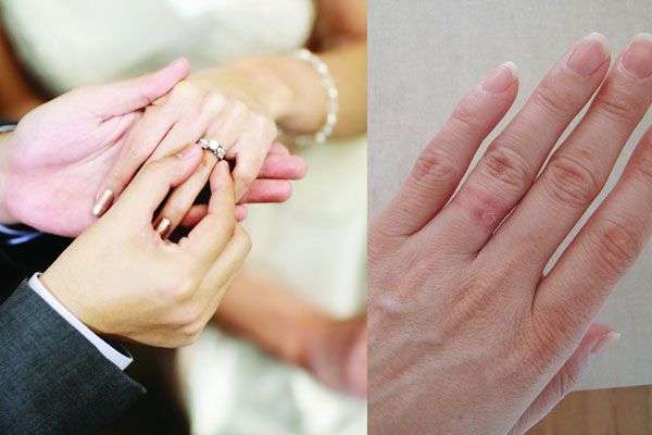 Allergic To Nickel Wedding Ring