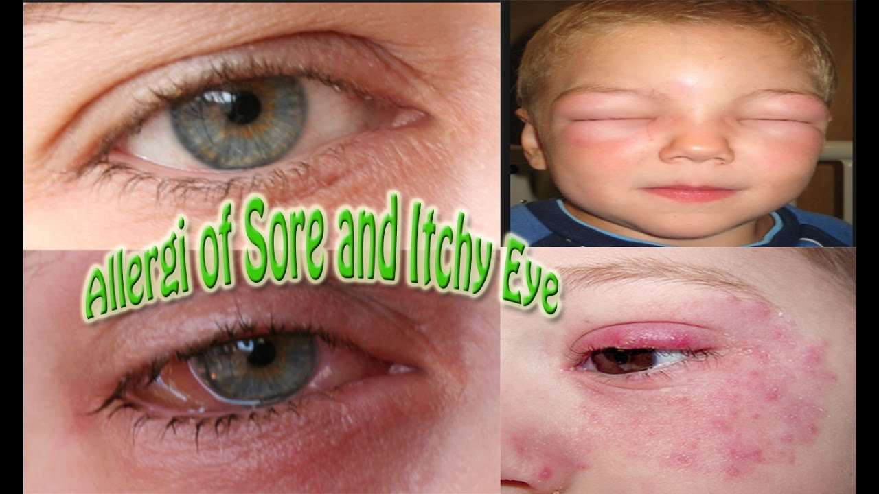Allergies of Sore and Itchy Eye âhow to prevent Allergies ...