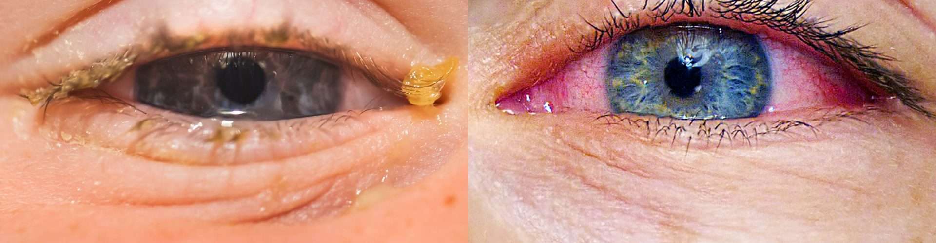 Allergies or Pink Eye: Heres How to Tell the Difference