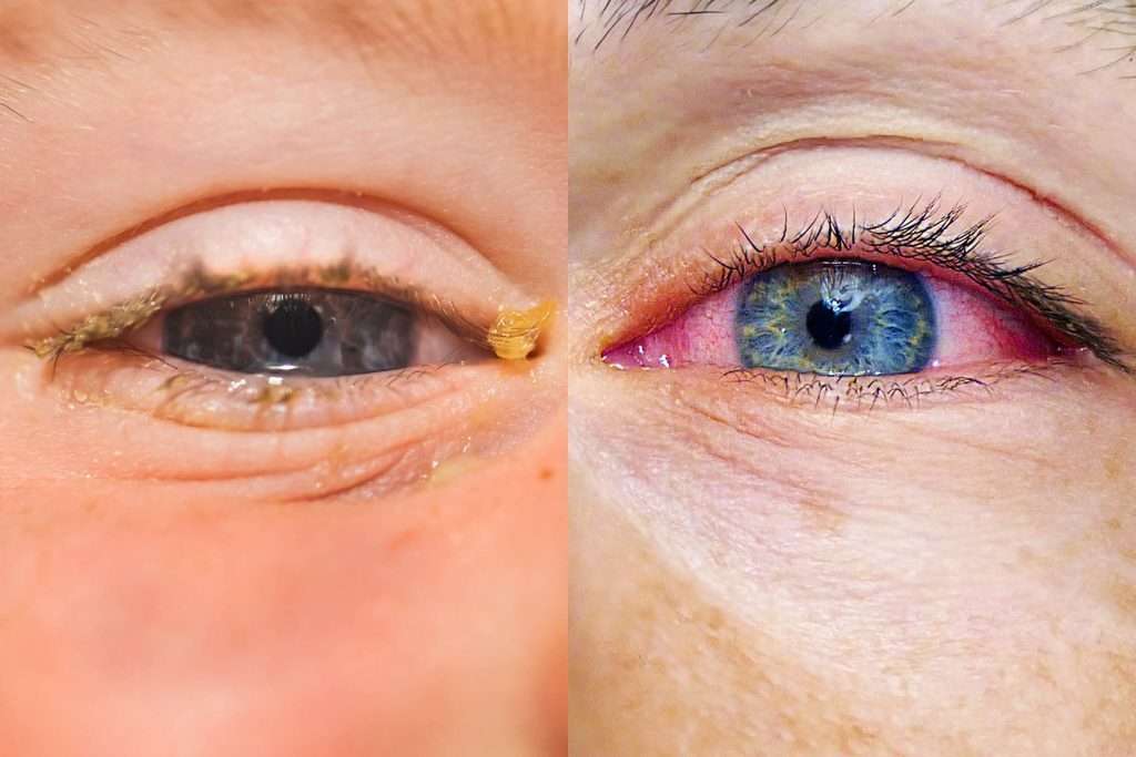 Allergies or Pink Eye: Here
