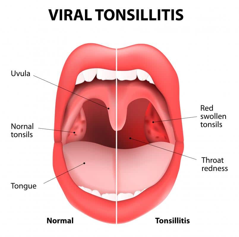Allergy And Swollen Tonsils