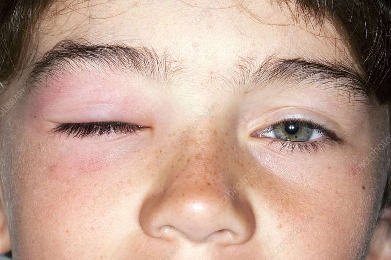 Allergy causing a swollen eye