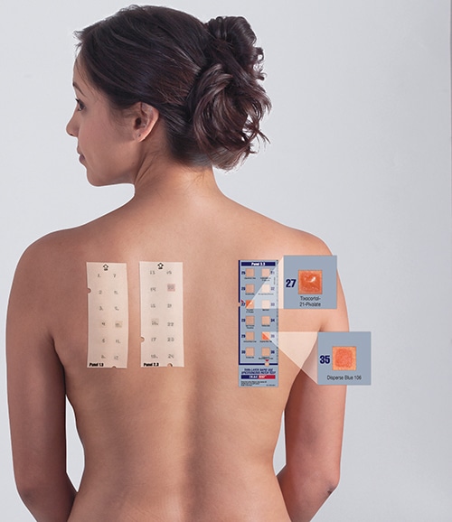 Allergy Patch Test