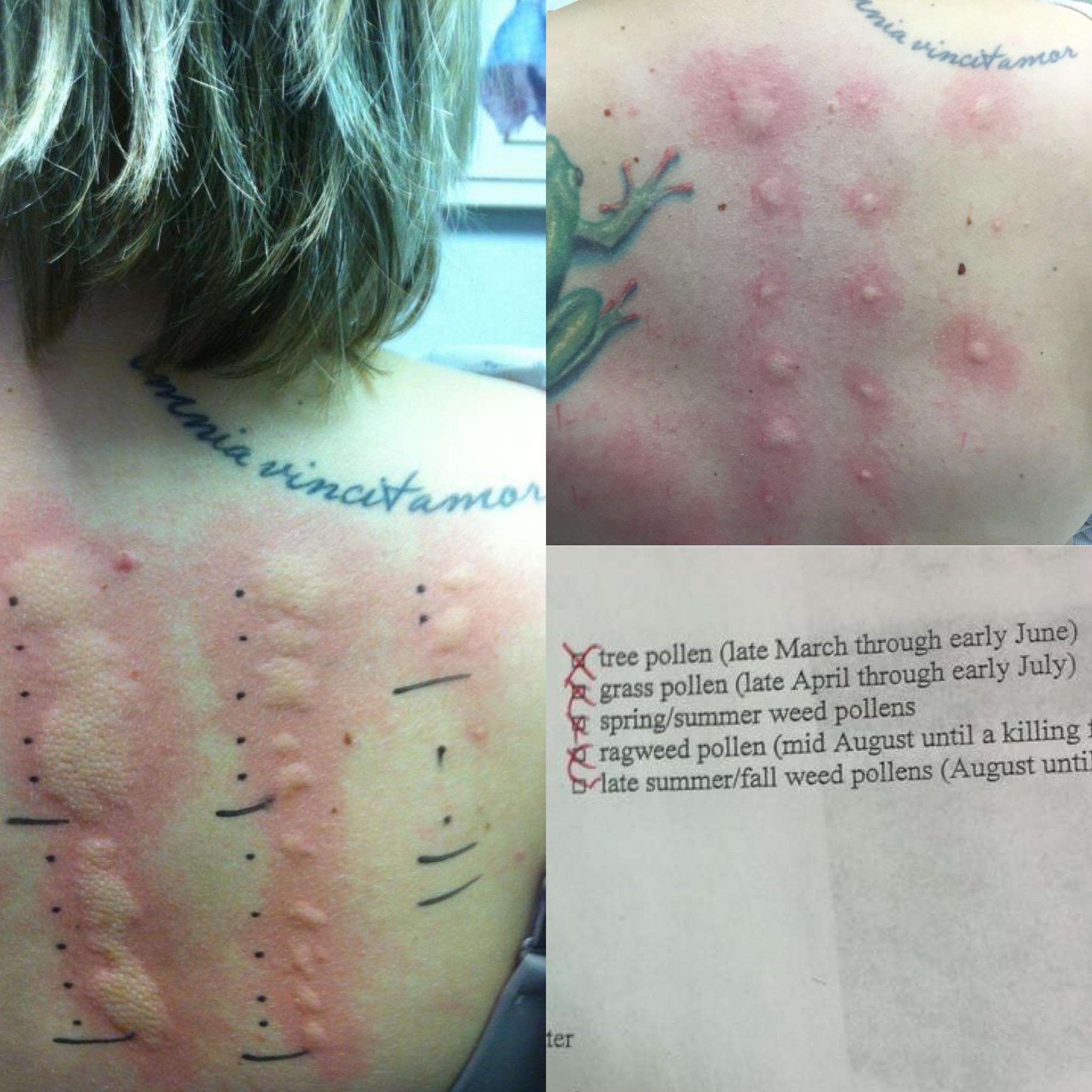 Allergy scratch tests, before (left) and after (top right) a year of ...