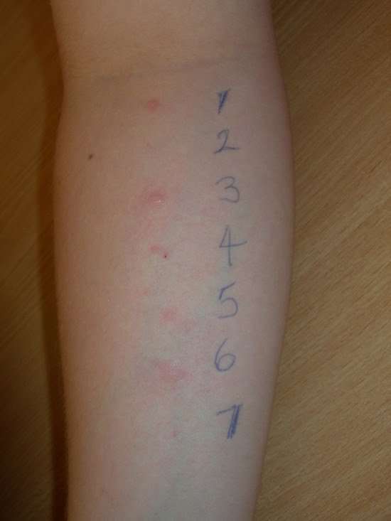 Allergy Skin Prick Test Results