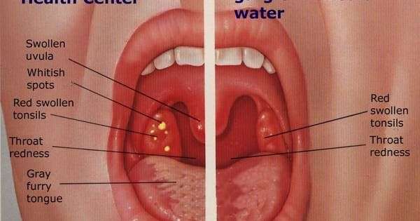 Allergy Sore Throat