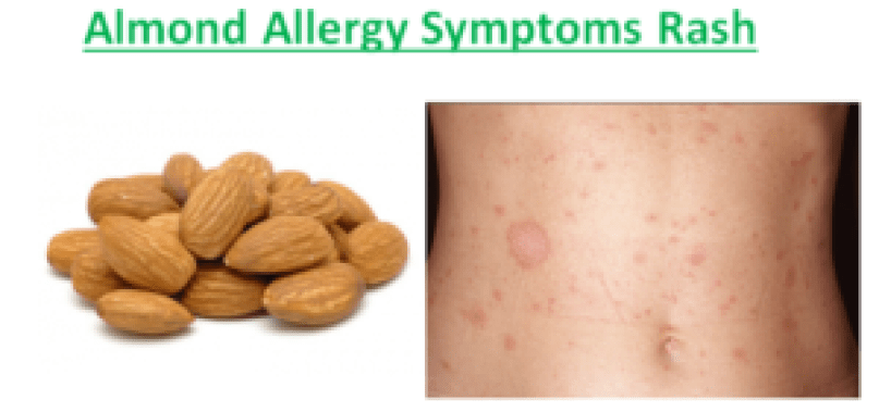 Almond Allergy Symptoms, Can you be allergic to Almonds ...