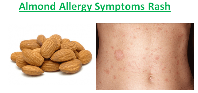 Almond Allergy Symptoms Rash