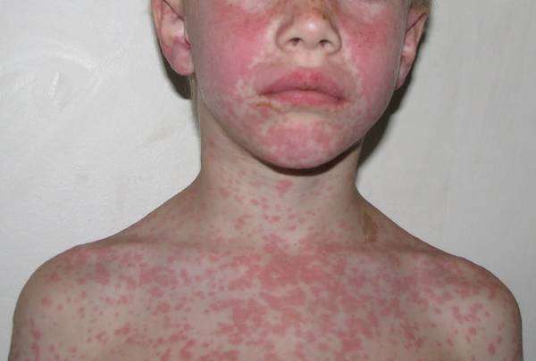 Amoxicillin Allergic Rash: Symptoms and Treatment