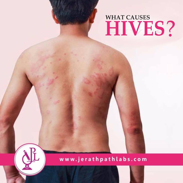 An allergic reaction can trigger hives. Things that commonly trigger an ...