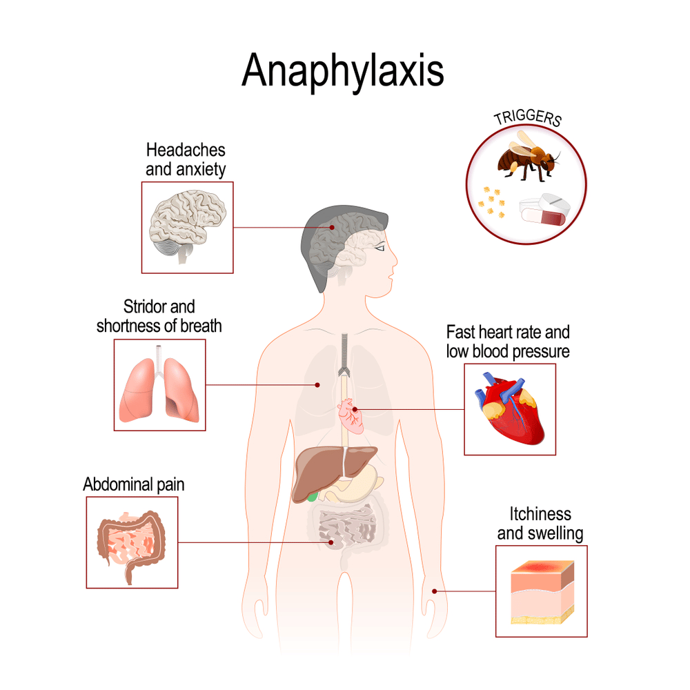 Anaphylaxis Myths and Facts â Cottonique