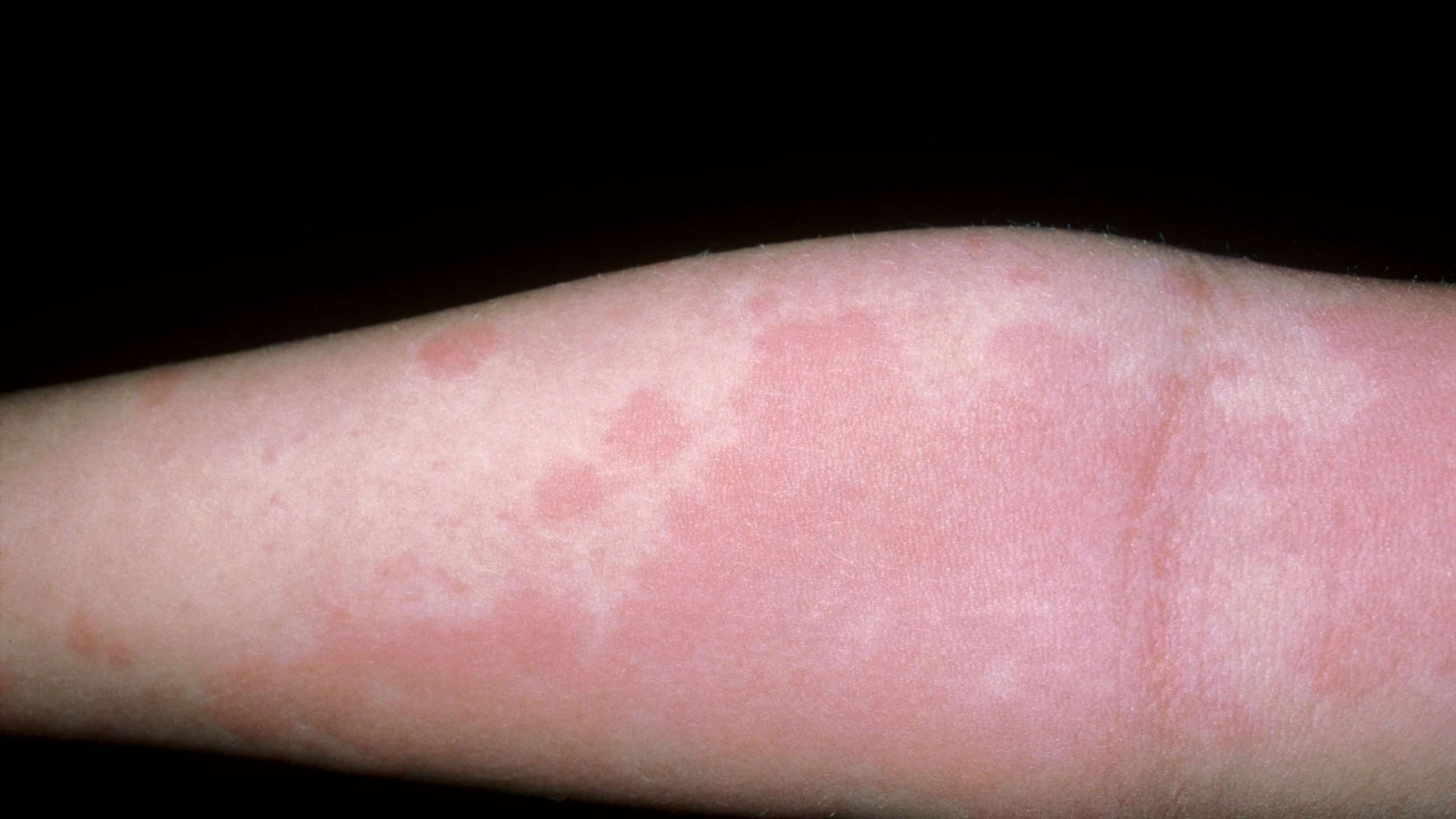 Anaphylaxis Rash : Urticaria Hives Allergy Anaphylaxis ...