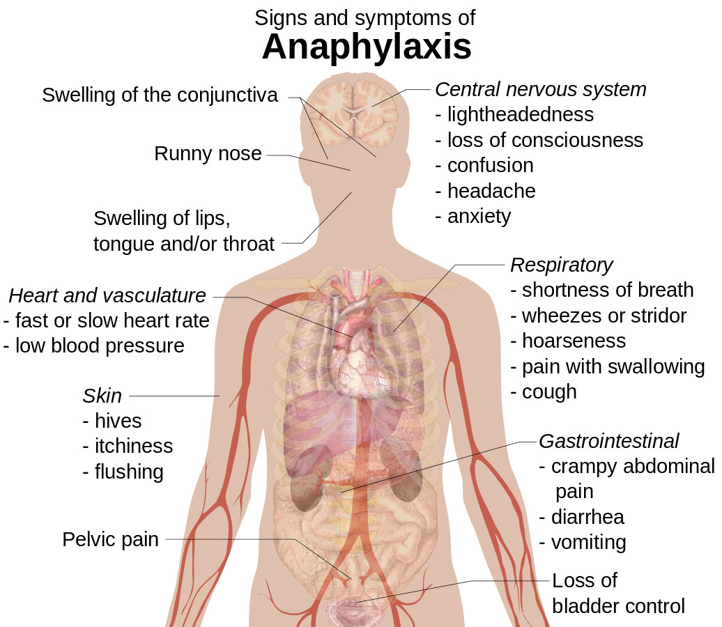 Anaphylaxis Symptoms