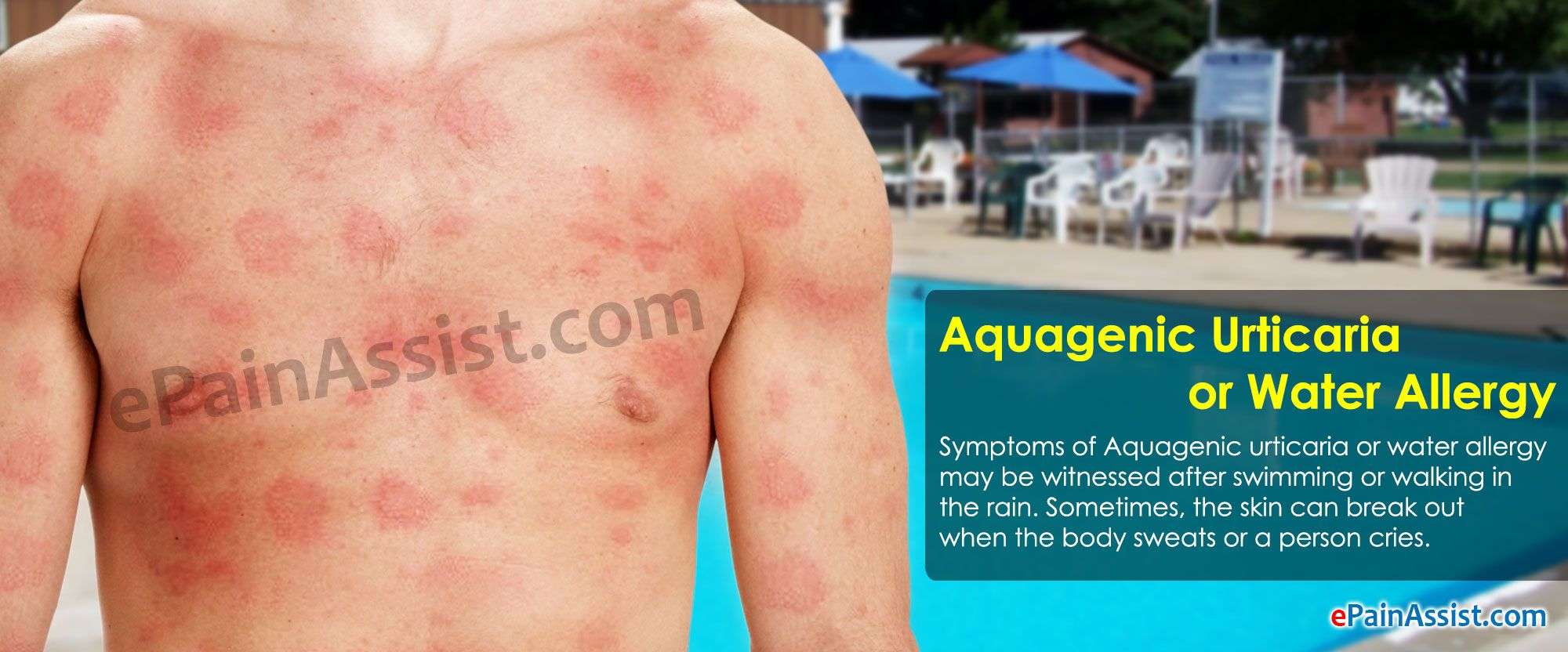 Aquagenic Urticaria or Water Allergy