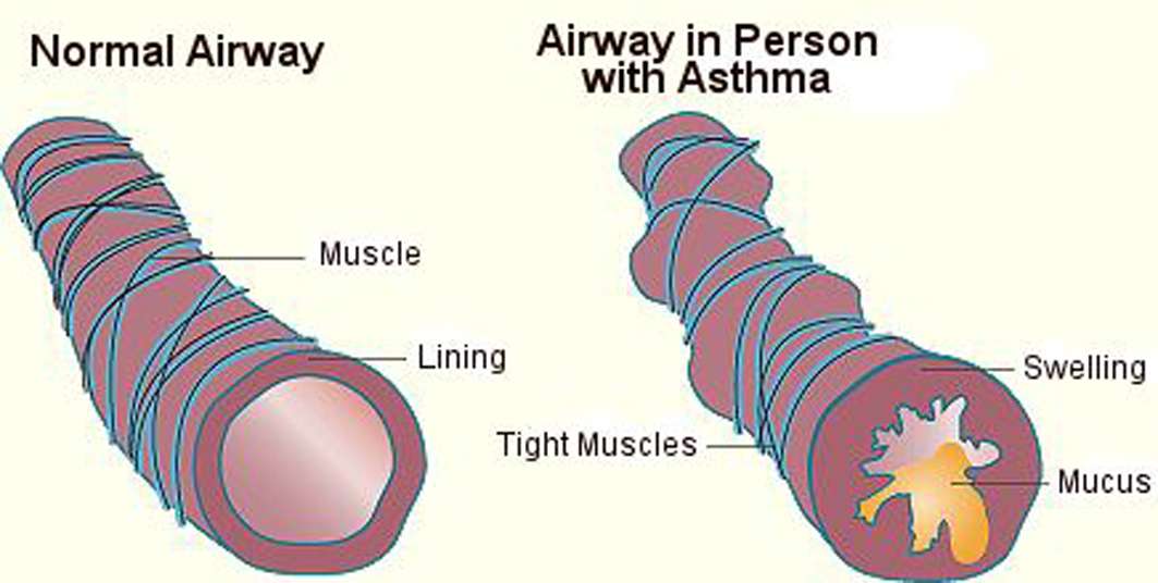 Asthma Airways Images